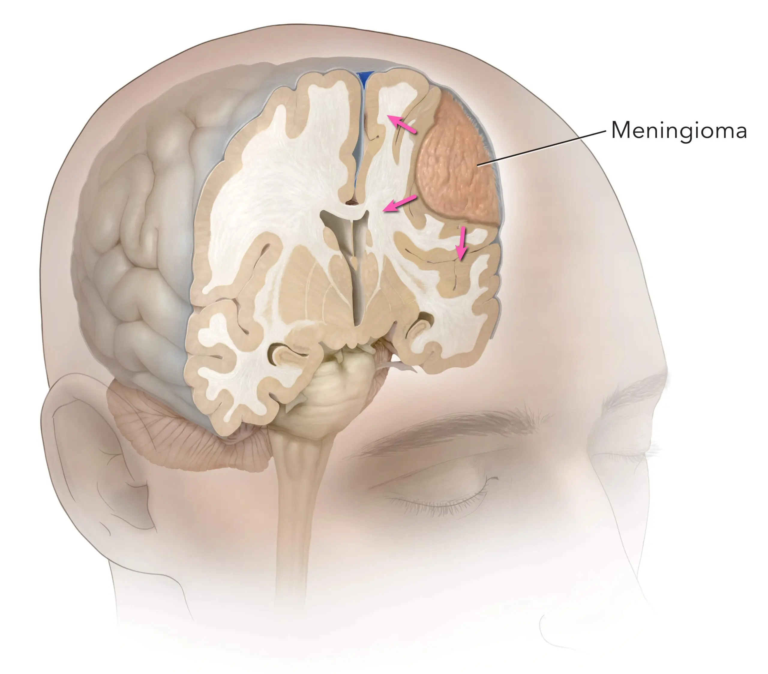 Idoso Tumor Rosto (Interna)