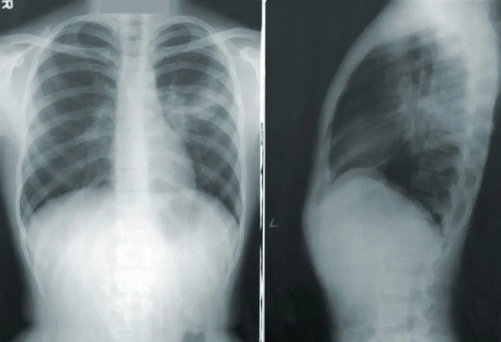 pneumonite abilio diniz
