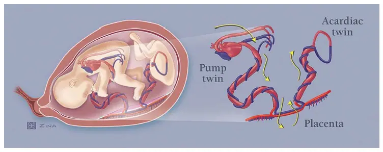 Ilustração de um caso de 'feto bomba' | Foto: Reprodução/US Davis Health Children's Hospital
