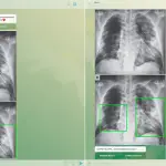 radiografia pulmonar, diagnóstico, covid-19, usp, marie, mnarie curie