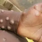 varíola dos macacos
