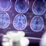 Alzheimer