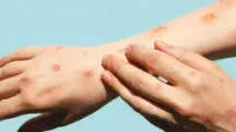 Mpox