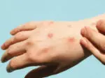 Mpox