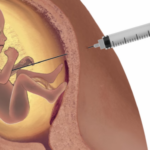 Aborto