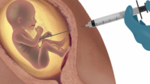 Aborto