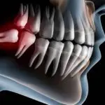 dente do siso -
