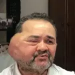 Idoso Tumor Rosto