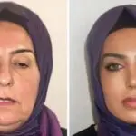 cirurgia plástica idosa turquia