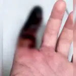 dedo necrosado Praia Grande picada aranha