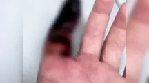 dedo necrosado Praia Grande picada aranha