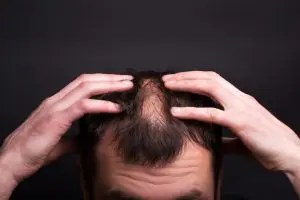 Homem calvo com mão na cabeça