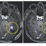 O paciente estudado tem um tumor chamado glioblastoma | Foto: Divulgação/The New England Journal of Medicine