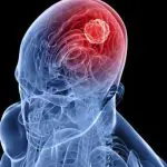 Imagem ilustrativa de um tumor no cérebro