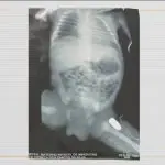 Radiografia mostra a bala alojada em uma das pernas da bebê | Foto: Reprodução/TV Globo