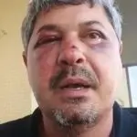 Depois do incidente, Saulo Jucá ficou com o rosto inchado | Foto: Reprodução/Redes sociais