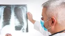 Liderado por Siow Ming Lee, professor de oncologia médica na University College London, o estudo visa a melhorar os resultados para pacientes com câncer de pulmão de células não pequenas | Foto: Divulgação/Pfizer | Imagem ilustrativa