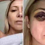 Fabiola Yáñes mostra hematomas no rosto