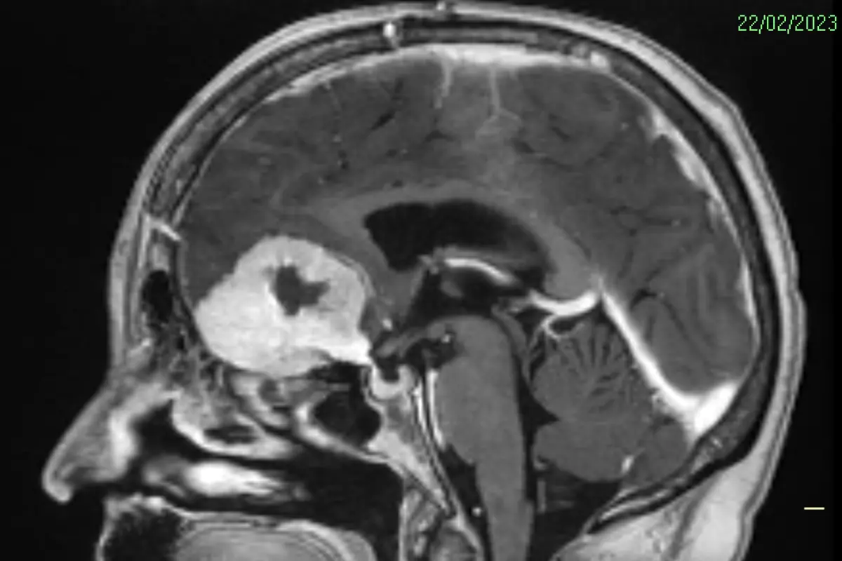 Imagem de tomografia de Doreen Adams mostra o tumor (massa branca) antes da cirurgia | Foto: Divulgação/NHS Grampian