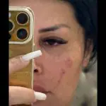Agressão no rosto sofrida pela influenciadora Adriana Muller