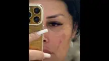 Agressão no rosto sofrida pela influenciadora Adriana Muller