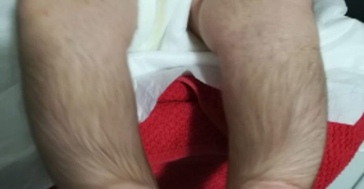 Caso de hipertricose em bebês | Foto: Reprodução/Dermatologic Therapy