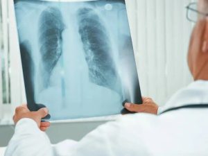 Médica examina imagem de pulmão de paciente: pesquisa pode assegurar ganho de eficiência em tratamento com menor efeito colateral | Foto: Divulgação/Agência SP