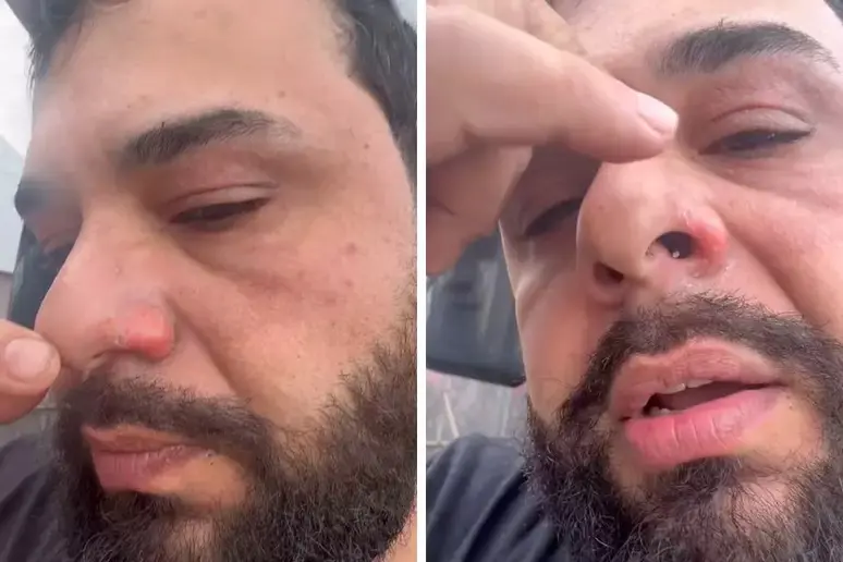 Léo Oliveira mostrou como ficou seu rosto depois de ser atingido por fogo em show | Foto: Reprodução/Instagram/@leo_leoeraphael