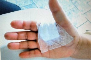 curativo dedo indicador
