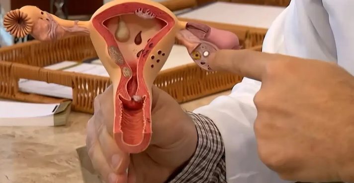 Endometriose: diagnóstico da doença cresceu 30% entre 2022 e 2024 | Foto: Reprodução/TV Brasil