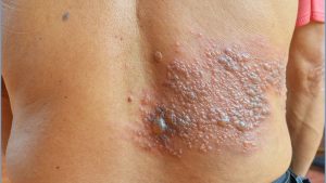 A herpes-zóster é causada pelo mesmo vírus que provoca a catapora | Foto: Divulgação/Ministério da Saúde