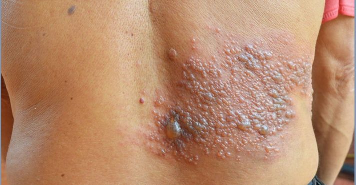 A herpes-zóster é causada pelo mesmo vírus que provoca a catapora | Foto: Divulgação/Ministério da Saúde